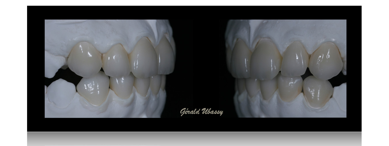 12 Veneers, Kina /Ubassy